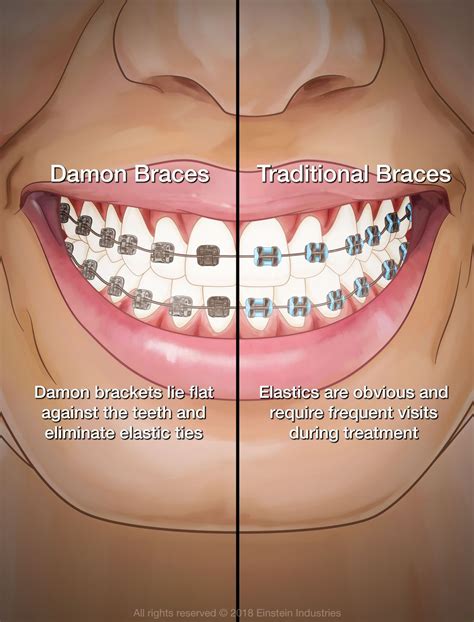 bracket damon metal|disadvantages of damon braces.